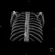 Hemangioma of rib: CT - Computed tomography